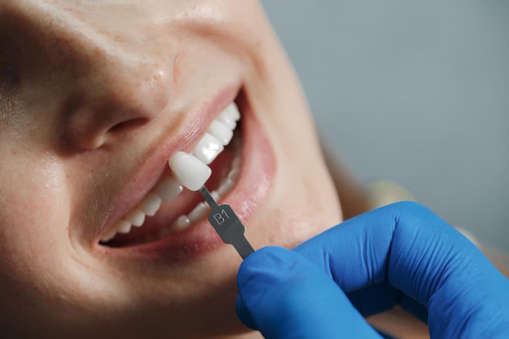 Zirconium Crowns